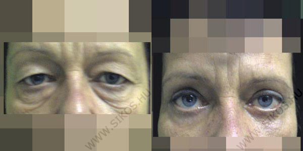 szem alatti petyhüdt bőr neutrogena anti wrinkle night cream